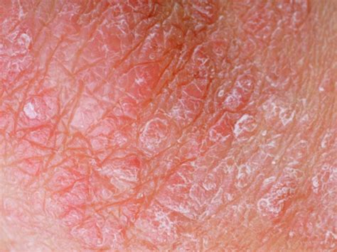 The third and final layer of skin is the subcutaneous zone. Skin diseases take big slice out of America's health, economy