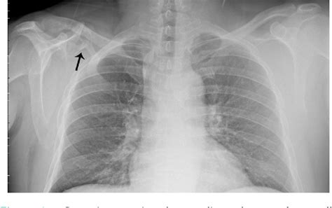 Figure 1 From Thoracic Suprascapular Nerve Compression Due To Rib