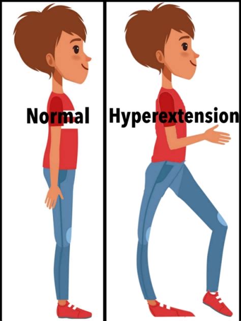 Knee Hyperextension After A Stroke Causes And Treatment Rehab HQ