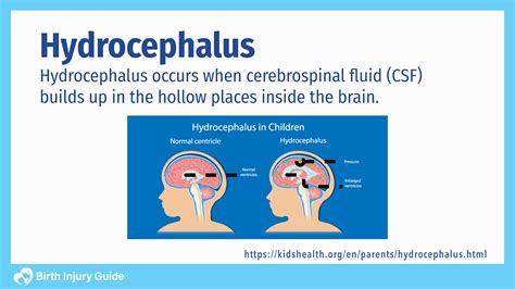 Hydrocephalus Birth Injury Guide