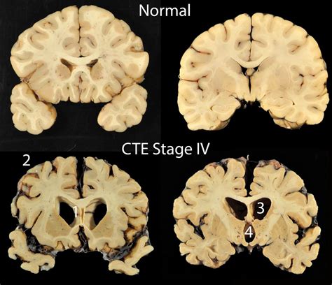 Cte can only be diagnosed after death by examining the brain. Nearly every former NFL player who donated brain for ...