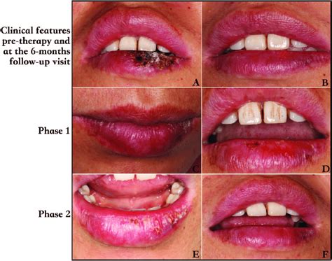 Clinical Images Showing The Lesion On The Left Side Of The Lower Lip