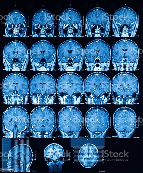 Mri Of The Brain Coronal View Stock Photo Download Image Now 2015