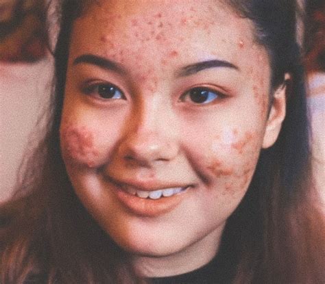 pin by anita life on acne positivity ️ beauty acne body