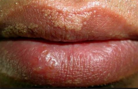 Small Fordyce Spot On Lips White Yellowish Granules Causes How To