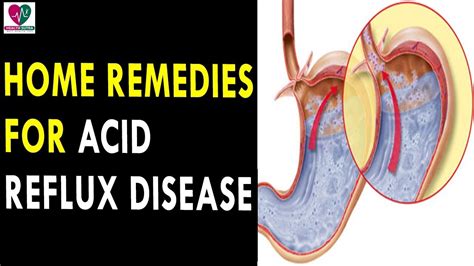 Have you tried aloe vera pills? Home Remedies for Acid Reflux Disease/ GERD || Health ...