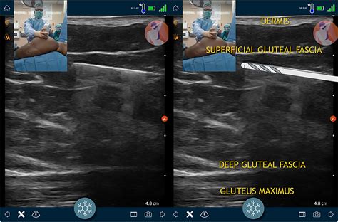 Ultrasound Guided Gluteal Fat Grafting Clinics In Plastic Surgery