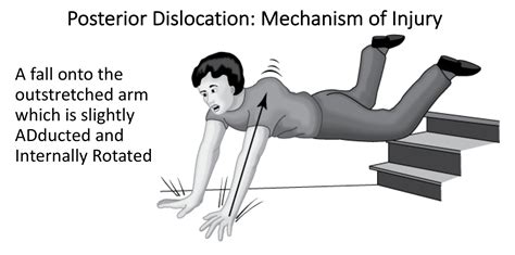 Instability Dislocation Cambridge Shoulder