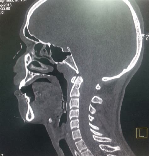 A Sagittal Computed Tomographic Ct Scanning Cervical Spine Image Of