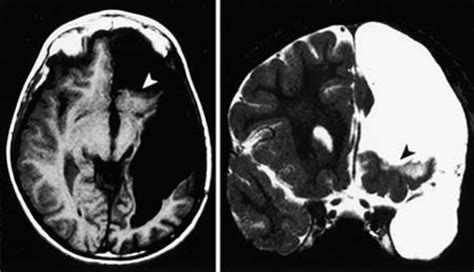Intractable Epilepsy After A Functional Hemispherectomy Important
