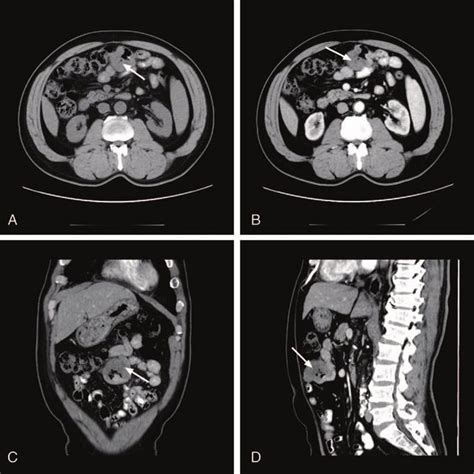 Abdominal Contrast Enhanced Computed Tomography Ct Revealed A Small