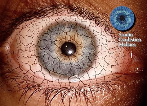 Sindrome Dell Occhio Secco Studio Oculistico Mellace