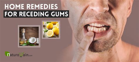 Top 10 Home Remedies For Receding Gums