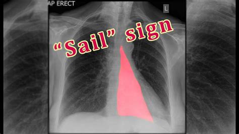 Left Lower Lobe Collapse Sail Sign انخماص الفص السفلي للرئة