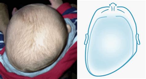 Everything You Need To Know About Flat Head Syndrome Toddle About