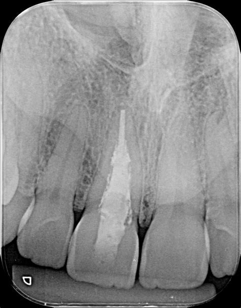 Tratamento Endodôntico tratamento de canal escurece o dente Blantus