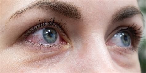U Of A Clinician Scientists Identify Pink Eye As Possible Primary