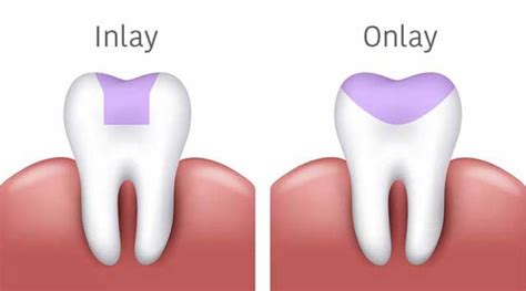 Inlay Onlay Vs Couronne Dentaire Medespoir Dentaire