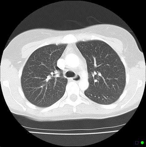 Normal Chest Ct Lung Window Image