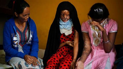 Victims Of Acid Attacks In India Saying New Law Restricting Sales Being