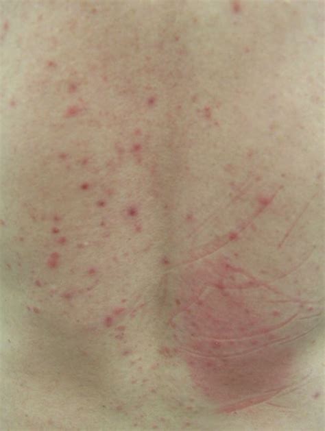 Clinical Challenge Itchy Rash On Back Mpr