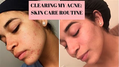How I Cleared My Acne Skin Care Routine Youtube