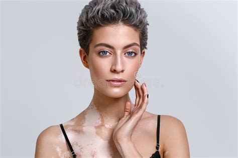 Vitiligo Woman Beauty Portrait Stock Image Image Of Caucasian Area
