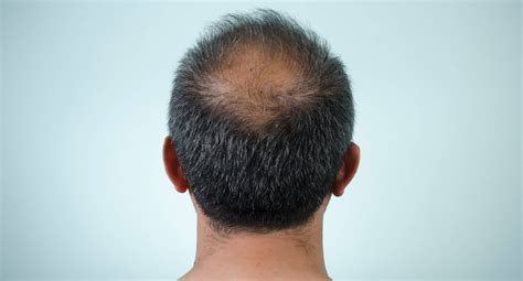 Quels sont les premiers signes d'une calvitie ? | Skin Clinic | Paris