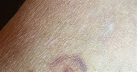 Mcelmurrays Mountain Retreat Tick Bite Lyme Disease