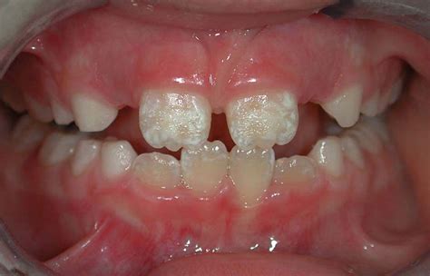Enamel Hypoplasia Causes Symptoms And Treatment Hubpages