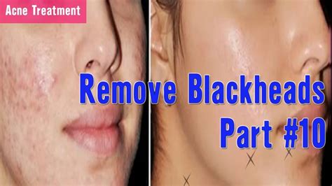 How To Remove Whiteheads On The Face Easy Part 10 Youtube