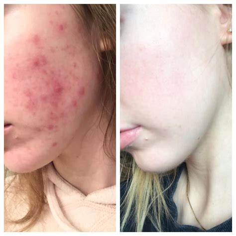 Acne Updated Before And After Pictures After A Full 6 Month Round Of