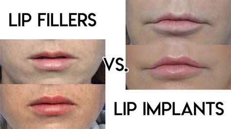 Lip Filler Vs Lip Implants Youtube