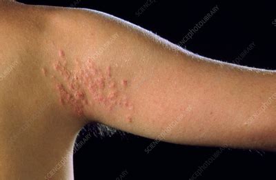 Cutaneous Larva Migrans Rash On Upper Arm Stock Image M