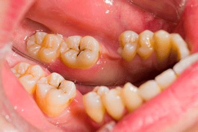 You don't want the decay to worsen. What is a Cavity and How Do They Form?
