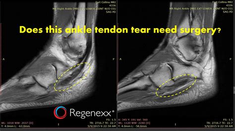 Can Torn Tendons Heal Naturally Depends On The Type Regenexx