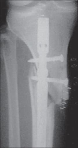 Proximal Third Tibia Fracture Trauma Orthobullets