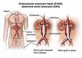 Pictures of Aortic Aneurysm Stent Recovery Time