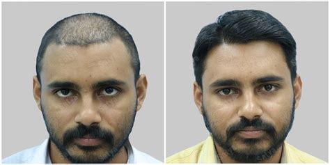 Hair Transplant In Dubai Uae Know The Cost And Procedure