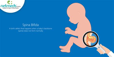 Spina Bifida Causes Diagnosis Prevention And Treatment