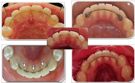 Fixed Vs Removable Orthodontic Retainers Tooth Implant London