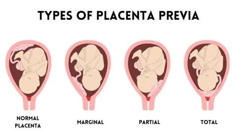 Placenta Previa Or Low Lying Placenta How Much Should You Be Concerned