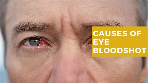 What Are The Causes Of Eye Bloodshot Chadderton Opticians