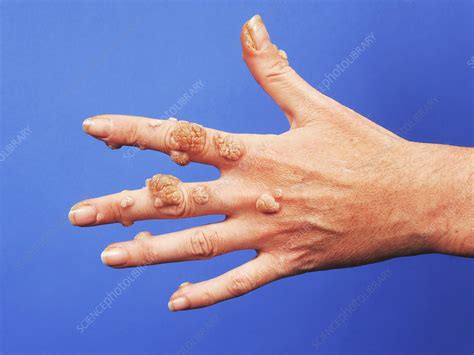 Wart Stock Image C0254598 Science Photo Library