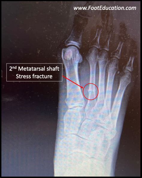 2nd Metatarsal Stress Fractures Footeducation