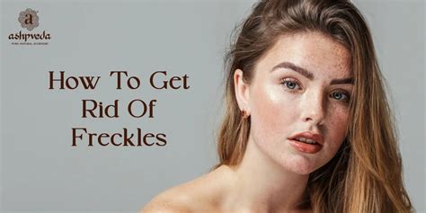 How To Get Rid Of Freckles Everything You Need To Know Ashpveda