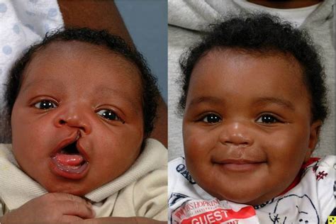 What You Need To Know About Cleft Lip And Cleft Palate Beyond Smile 247