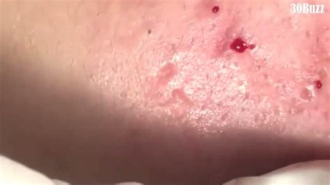 03 Huge Acne Pimples Blackheads Popping Up Satisfying With Oddly Calm