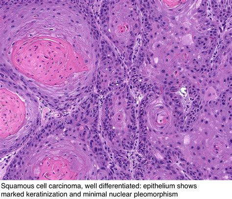 It is commonly abbreviated scc. Pathology Outlines - Squamous cell carcinoma