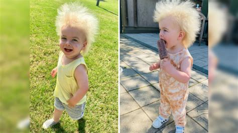 Rare Condition Makes Toddler Look Like Einstein One Of Hundred In The